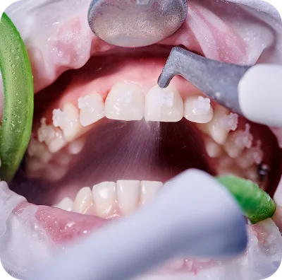 Soin réalisé sur les dents d’un enfant, écarteurs en place