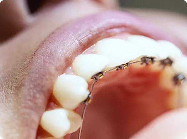 Appareil orthodontique multi-attaches posé sur les dents