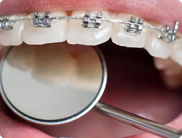 Bagues orthodontiques vues au miroir dentaire