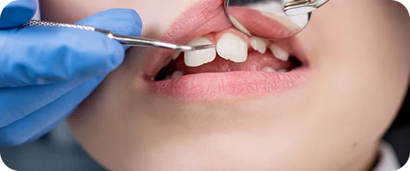 Bouche d’enfant lors d’un contrôle dentaire