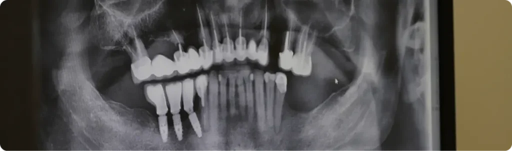 Radiographie panoramique : implants dentaires en place dans l’os de la mâchoire, sous des couronnes